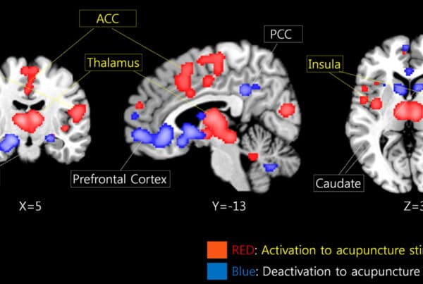 brain_image_acupuncture