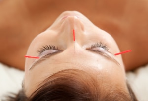 Cosmetic Acupuncture