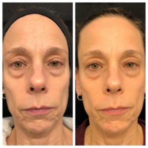 Before After Facial Rejuvenation Cosmetic Acupuncture