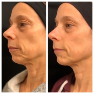 Jen Before and After NoTox BoTox™